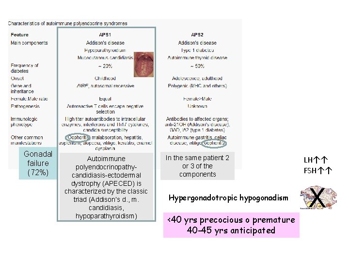 Gonadal failure (72%) Autoimmune polyendocrinopathycandidiasis-ectodermal dystrophy (APECED) is characterized by the classic triad (Addison’s