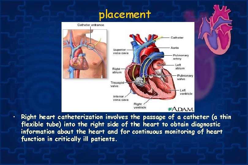 placement • Right heart catheterization involves the passage of a catheter (a thin flexible