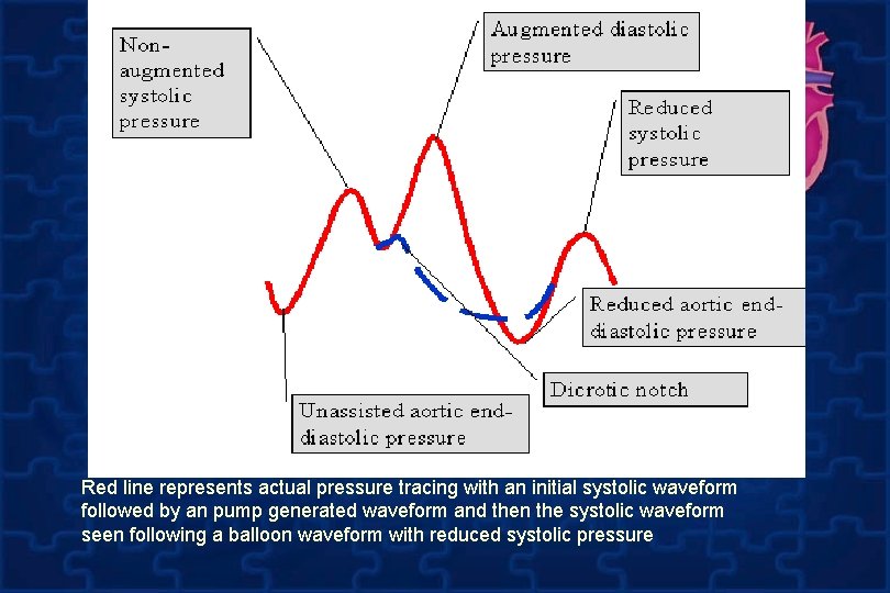 Red line represents actual pressure tracing with an initial systolic waveform followed by an