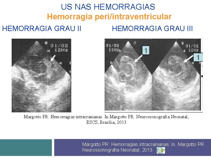 US NAS HEMORRAGIAS Hemorragia peri/intraventricular HEMORRAGIA GRAU II HEMORRAGIA GRAU III Margotto PR. Hemorragias