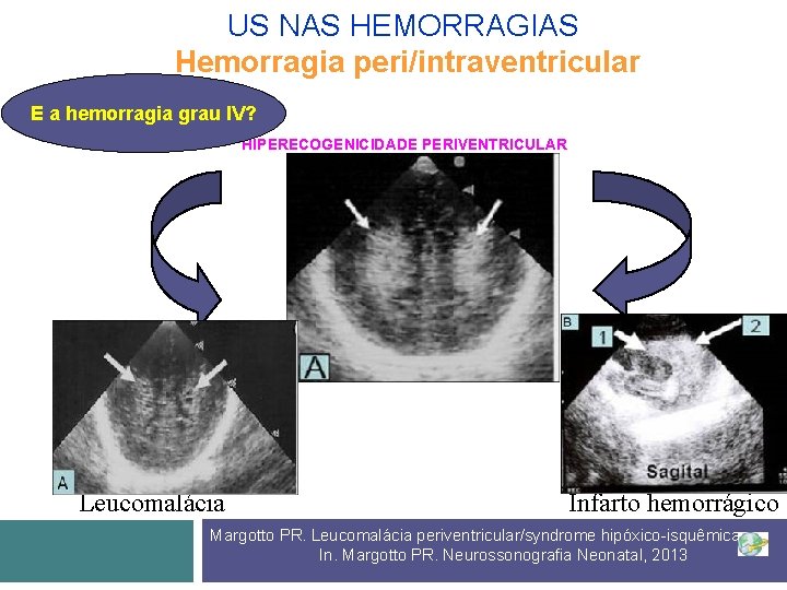 US NAS HEMORRAGIAS Hemorragia peri/intraventricular E a hemorragia grau IV? HIPERECOGENICIDADE PERIVENTRICULAR Leucomalácia Infarto