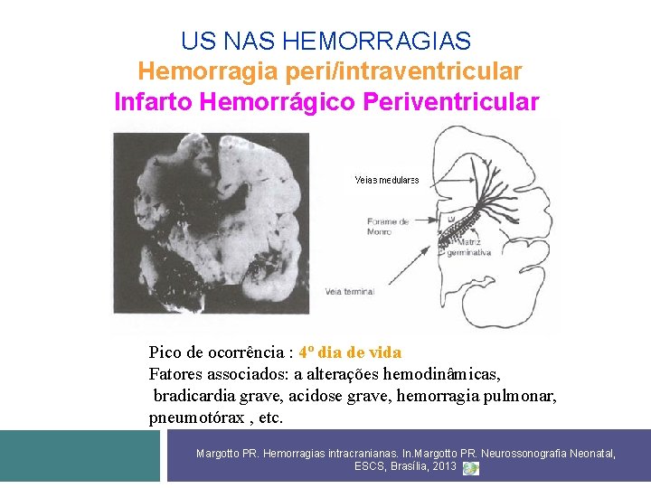 US NAS HEMORRAGIAS Hemorragia peri/intraventricular Infarto Hemorrágico Periventricular Pico de ocorrência : 4º dia