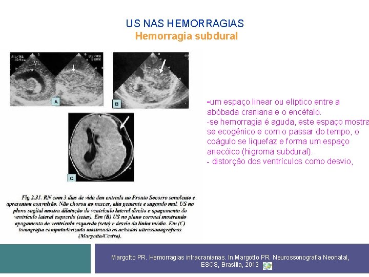 US NAS HEMORRAGIAS Hemorragia subdural -um espaço linear ou elíptico entre a abóbada craniana