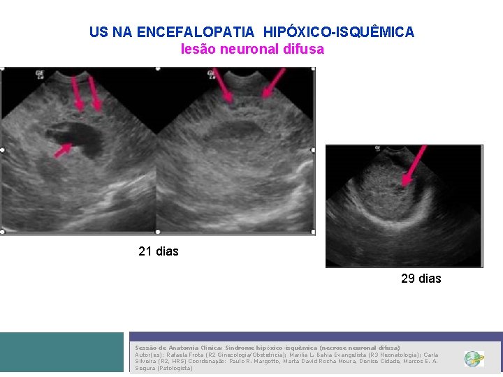 US NA ENCEFALOPATIA HIPÓXICO-ISQUÊMICA lesão neuronal difusa 21 dias 29 dias Sessão de Anatomia