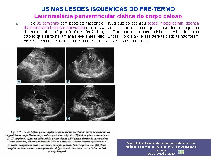 US NAS LESÕES ISQUÊMICAS DO PRÉ-TERMO Leucomalácia periventricular cística do corpo caloso RN de