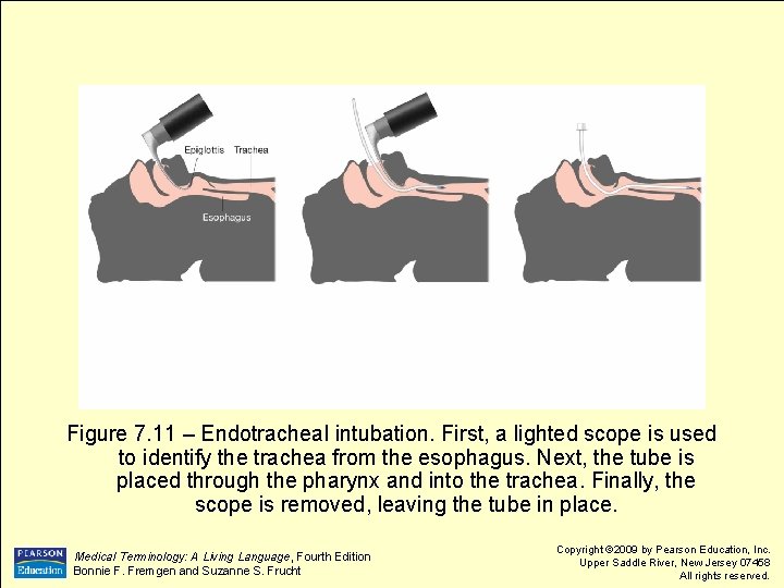 Figure 7. 11 – Endotracheal intubation. First, a lighted scope is used to identify