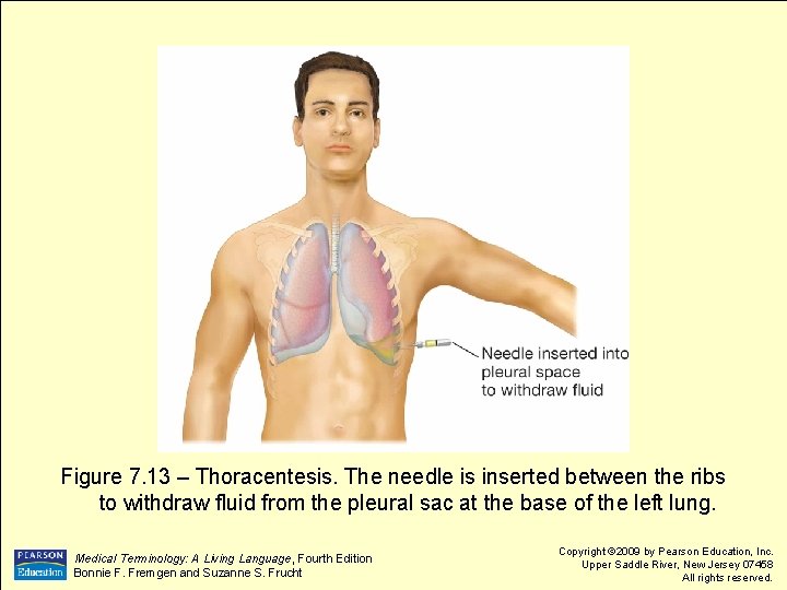 Figure 7. 13 – Thoracentesis. The needle is inserted between the ribs to withdraw