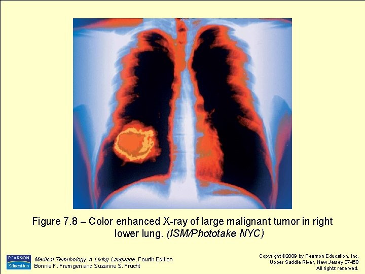 Figure 7. 8 – Color enhanced X-ray of large malignant tumor in right lower