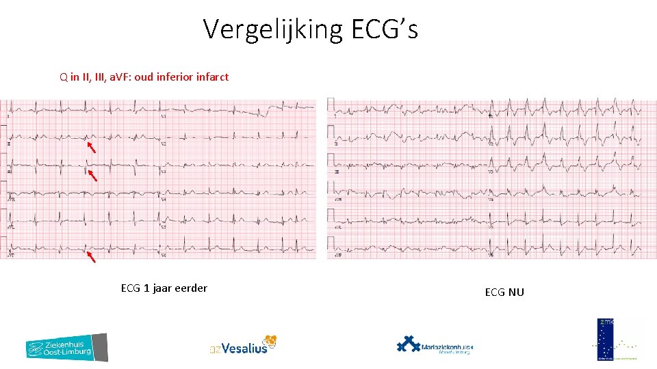 Vergelijking ECG’s Q in II, III, a. VF: oud inferior infarct ECG 1 jaar