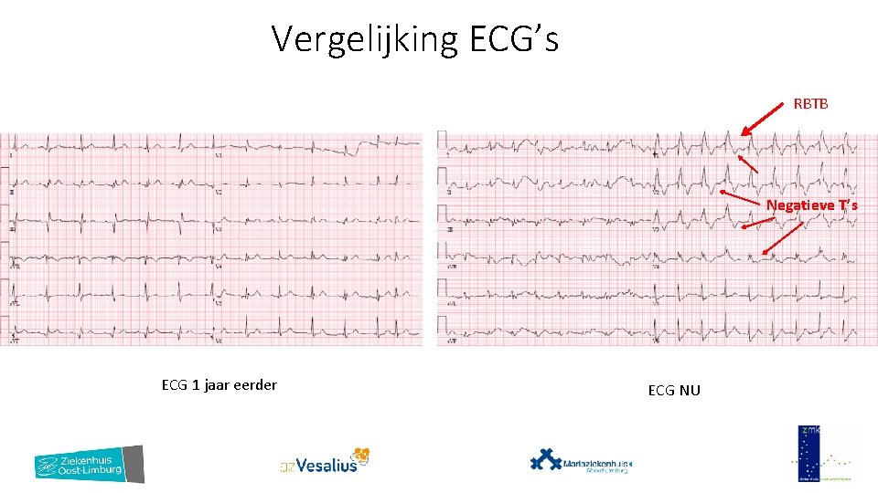 Vergelijking ECG’s RBTB Negatieve T’s ECG 1 jaar eerder ECG NU 