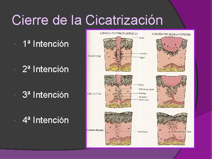 Cierre de la Cicatrización 1ª Intención 2ª Intención 3ª Intención 4ª Intención Cierre de la Cicatrización 1ª Intención 2ª Intención 3ª Intención 4ª Intención