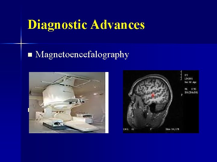 Diagnostic Advances n n Magnetoencefalography 