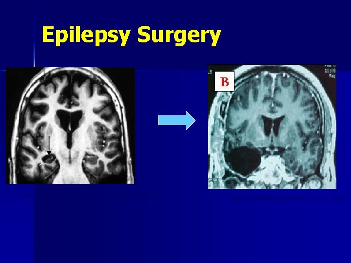 Epilepsy Surgery http: //www. rch. unimelb. edu. au/cep/Media/brain/mri 6. jpg http: //www. fleni. org.