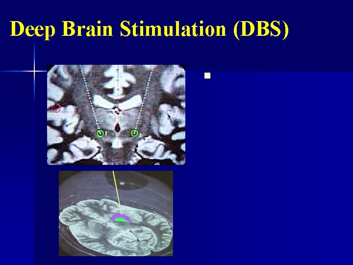 Deep Brain Stimulation (DBS) n 