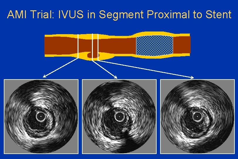 AMI Trial: IVUS in Segment Proximal to Stent 