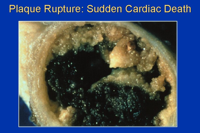 Plaque Rupture: Sudden Cardiac Death 