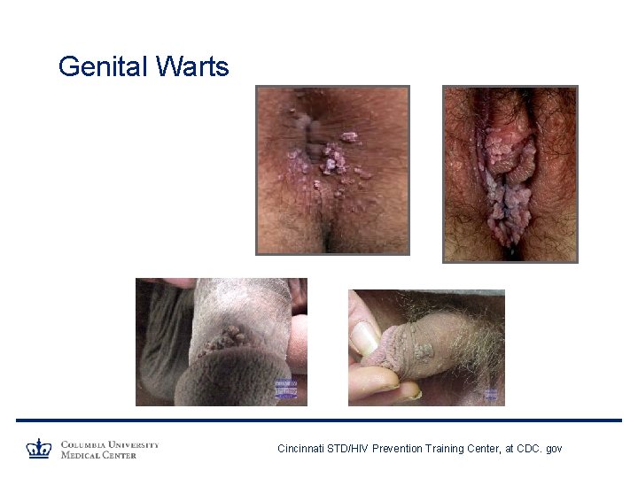 Genital Warts Cincinnati STD/HIV Prevention Training Center, at CDC. gov 