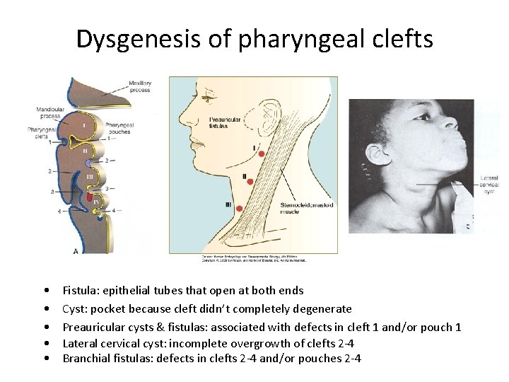 Dysgenesis of pharyngeal clefts • • • Fistula: epithelial tubes that open at both