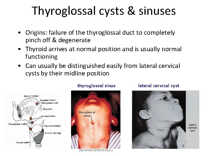 Thyroglossal cysts & sinuses • Origins: failure of the thyroglossal duct to completely pinch