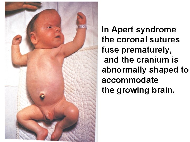 In Apert syndrome the coronal sutures fuse prematurely, and the cranium is abnormally shaped