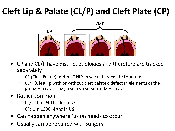 Cleft Lip & Palate (CL/P) and Cleft Plate (CP) CL/P CP • CP and