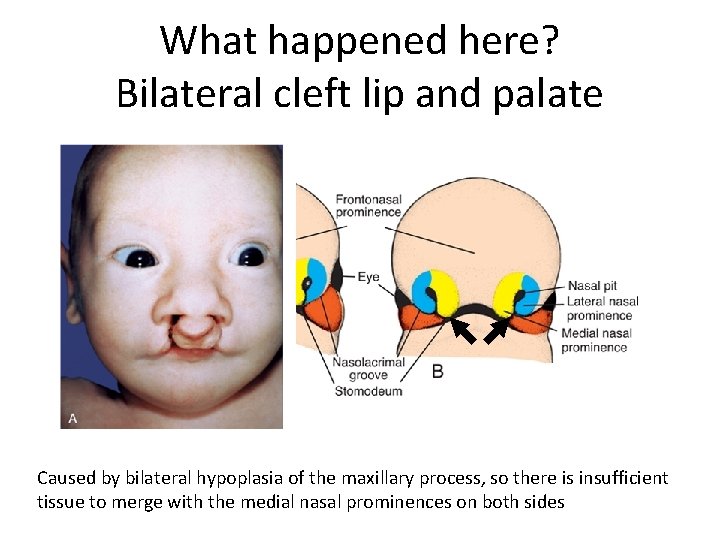 What happened here? Bilateral cleft lip and palate Caused by bilateral hypoplasia of the