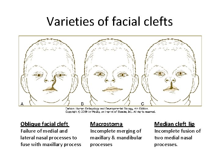 Varieties of facial clefts Oblique facial cleft Failure of medial and lateral nasal processes