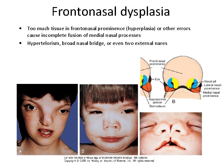 Frontonasal dysplasia • Too much tissue in frontonasal prominence (hyperplasia) or other errors cause