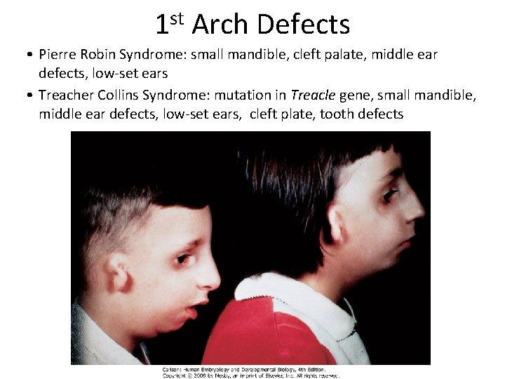 1 st Arch Defects • Pierre Robin Syndrome: small mandible, cleft palate, middle ear