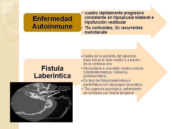 Enfermedad Autoinmune Fístula Laberíntica • cuadro rápidamente progresivo consistente en hipoacusia bilateral e hipofunción
