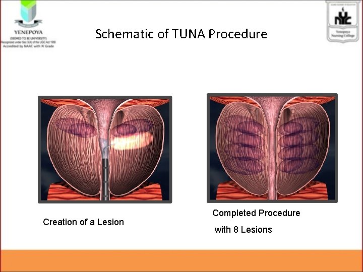 Schematic of TUNA Procedure Creation of a Lesion Completed Procedure with 8 Lesions 