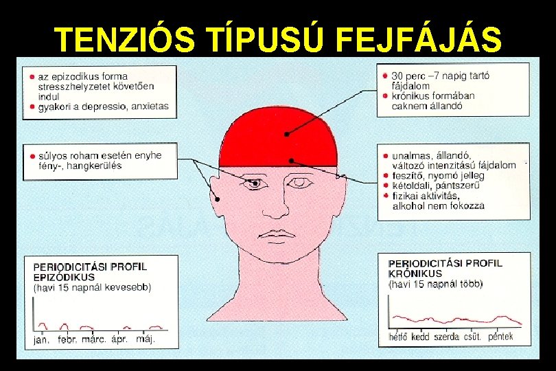 TENZIÓS TÍPUSÚ FEJFÁJÁS 