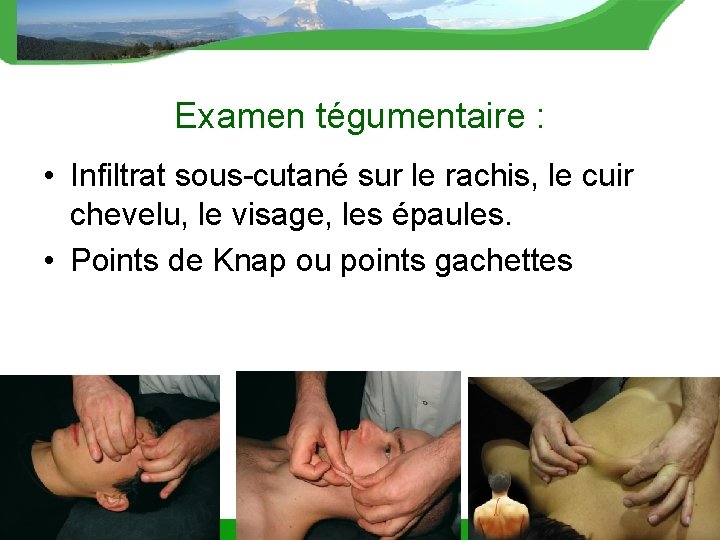 Examen tégumentaire : • Infiltrat sous-cutané sur le rachis, le cuir chevelu, le visage,