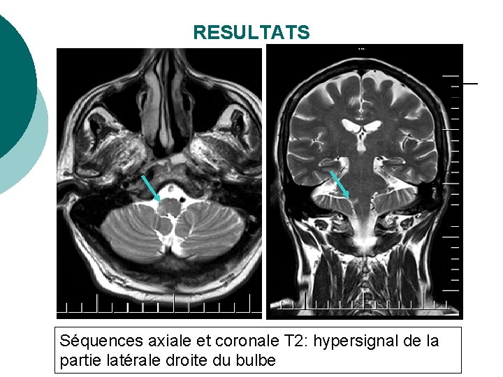 RESULTATS Séquences axiale et coronale T 2: hypersignal de la partie latérale droite du