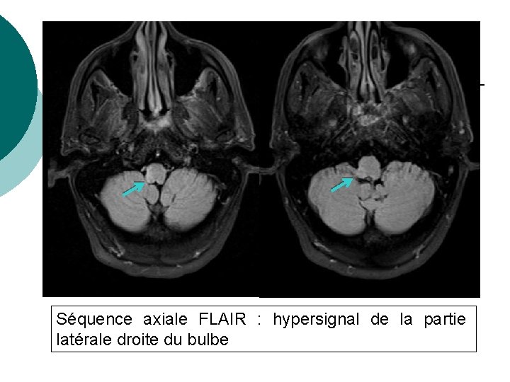 Séquence axiale FLAIR : hypersignal de la partie latérale droite du bulbe 