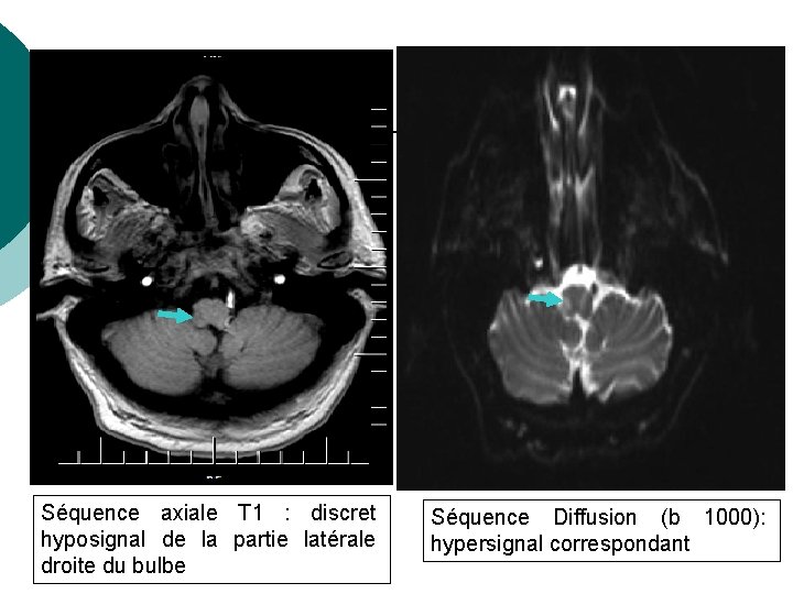 RESULTATS Séquence axiale T 1 : discret hyposignal de la partie latérale droite du