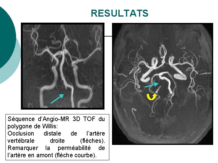 RESULTATS Séquence d’Angio-MR 3 D TOF du polygone de Willis: Occlusion distale de l’artère