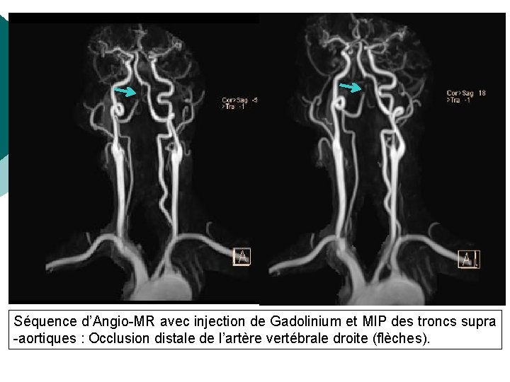 Séquence d’Angio-MR avec injection de Gadolinium et MIP des troncs supra -aortiques : Occlusion