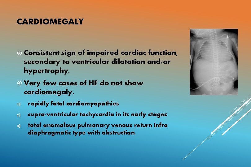 CARDIOMEGALY Consistent sign of impaired cardiac function, secondary to ventricular dilatation and/or hypertrophy. Very