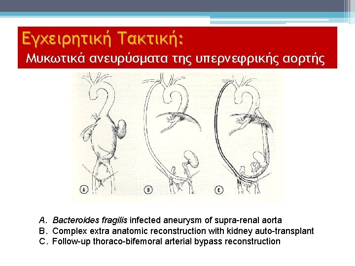 Εγχειρητική Τακτική: Μυκωτικά ανευρύσματα της υπερνεφρικής αορτής A. Bacteroides fragilis infected aneurysm of supra-renal