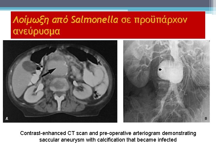 Λοίμωξη από Salmonella σε προϋπάρχον ανεύρυσμα Contrast-enhanced CT scan and pre-operative arteriogram demonstrating saccular