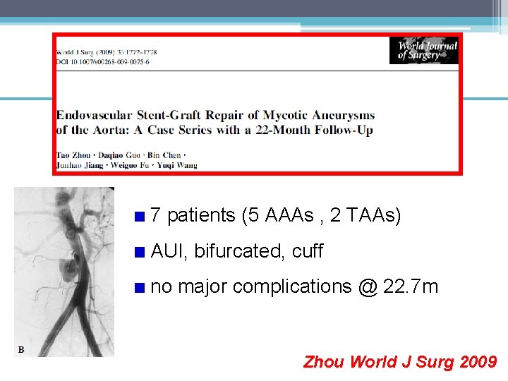 7 patients (5 AAAs , 2 TAAs) AUI, bifurcated, cuff no major complications @
