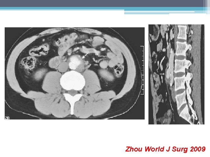 Zhou World J Surg 2009 