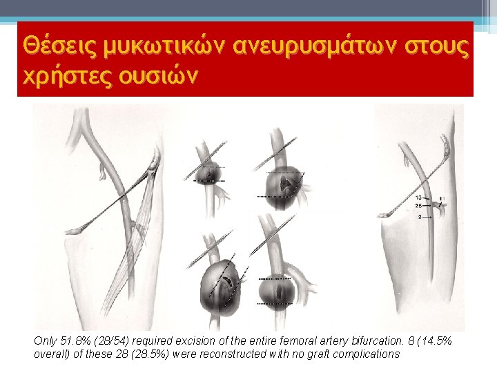 Θέσεις μυκωτικών ανευρυσμάτων στους χρήστες ουσιών Only 51. 8% (28/54) required excision of the