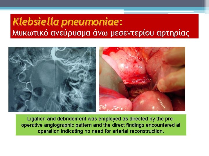 Klebsiella pneumoniae: pneumoniae Μυκωτικό ανεύρυσμα άνω μεσεντερίου αρτηρίας Ligation and debridement was employed as