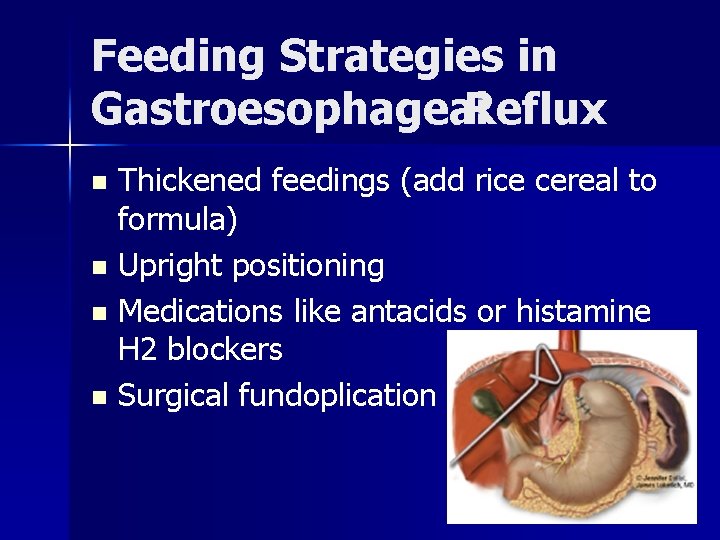Feeding Strategies in Gastroesophageal Reflux Thickened feedings (add rice cereal to formula) n Upright