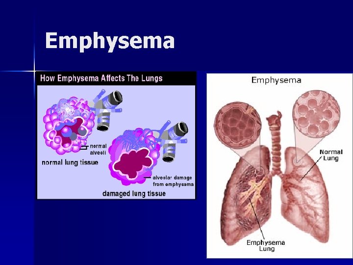 Emphysema 