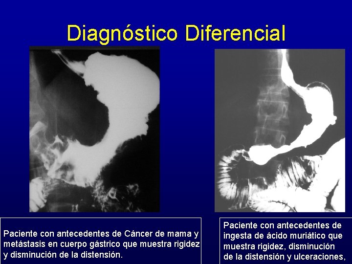 Diagnóstico Diferencial Paciente con antecedentes de Cáncer de mama y metástasis en cuerpo gástrico