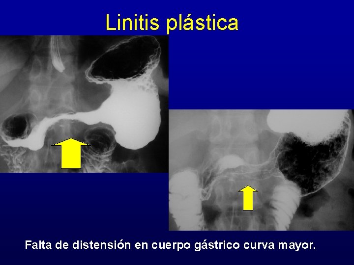 Linitis plástica Falta de distensión en cuerpo gástrico curva mayor. 
