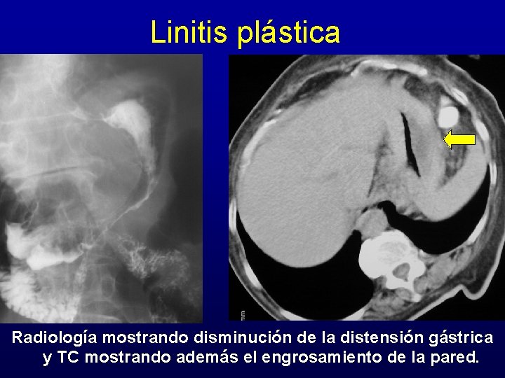 Linitis plástica Radiología mostrando disminución de la distensión gástrica y TC mostrando además el